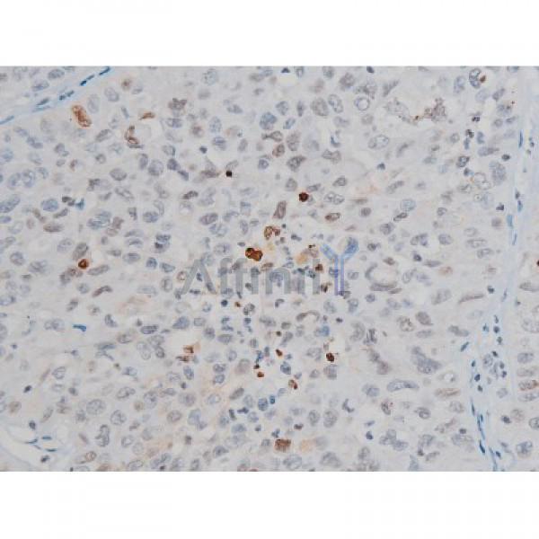 Phospho-Histone H2A.X (Ser139)[Ser140] Antibody - AF3187 at 1/200 staining Human lung cancer tissue sections by IHC-P.